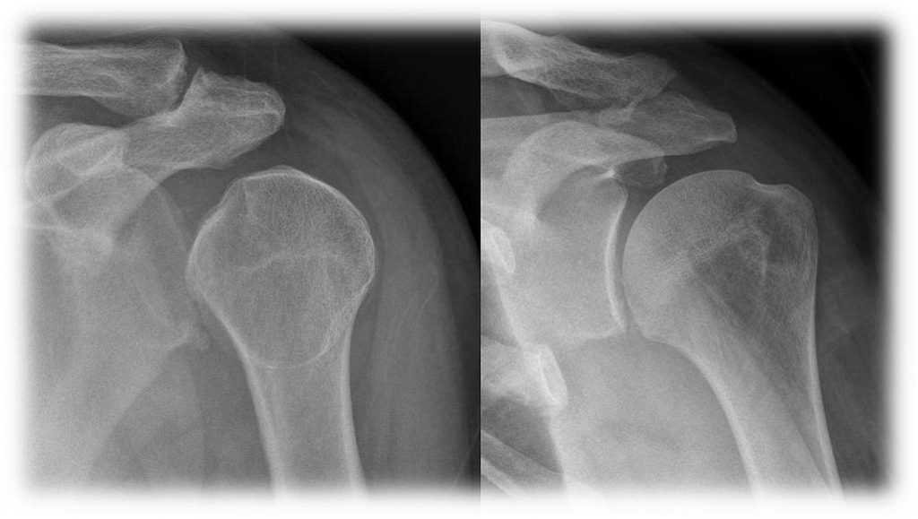 xrayfor_shoulder